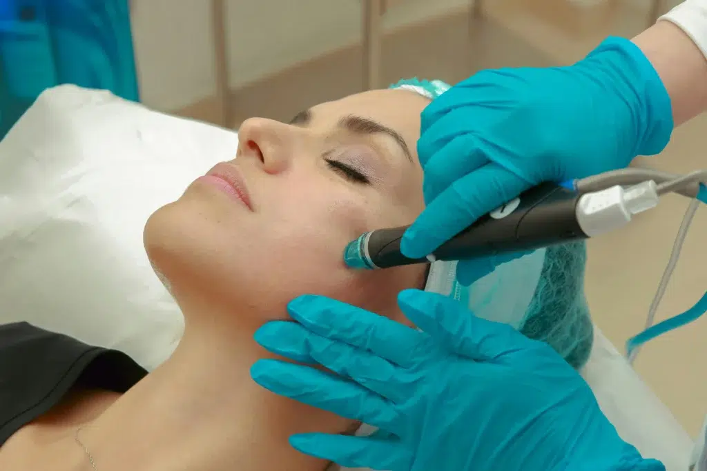 A woman lying on bed having Microneedling Treatment in Bradenton FL