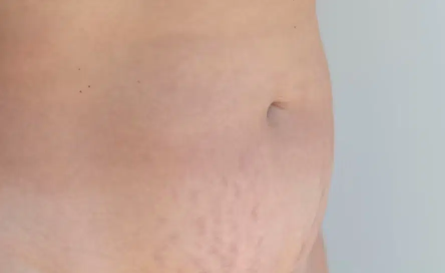 Body Stretch Marks Treatment – Abdomen, Thighs, Arms