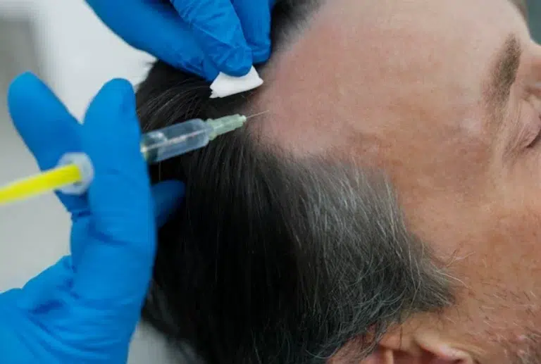 What Is PRP Hair Restoration (2) What Is PRP Hair Restoration (2)