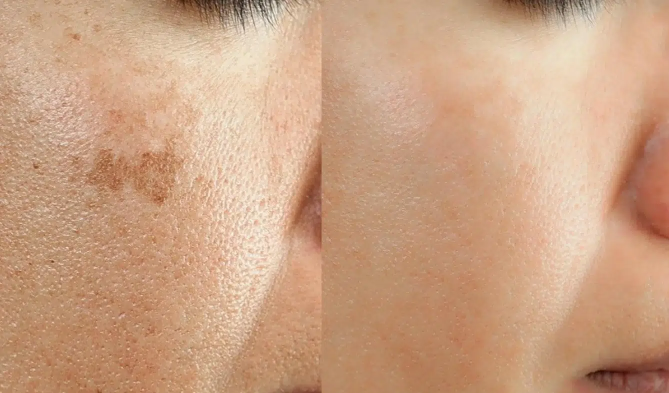 Age Spots vs Sun Damage: How to Tell the Difference