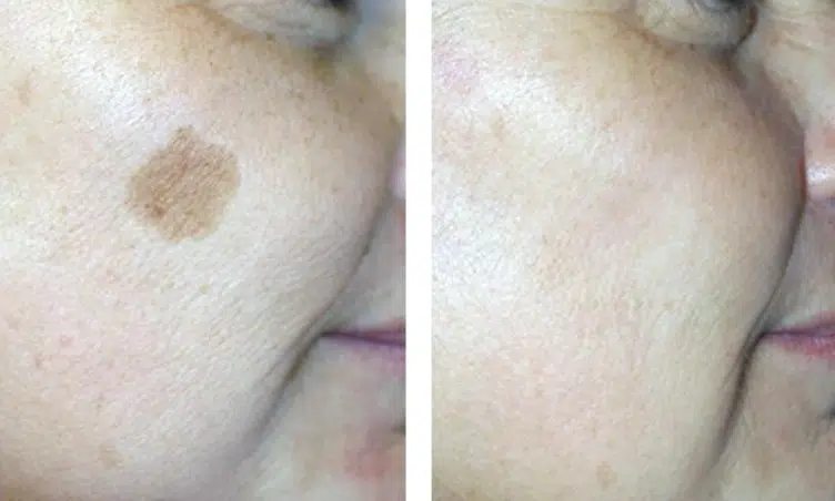 Age Spots vs Sun Damage: How to Tell the Difference