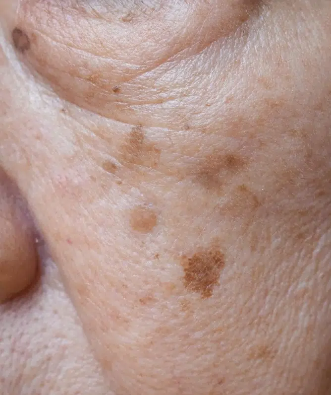 Age Spots vs Sun Damage: How to Tell the Difference