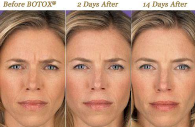 BOTOX vs Dysport vs Jeuveau What Is the Difference