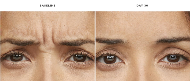BOTOX vs Dysport vs Jeuveau What Is the Difference