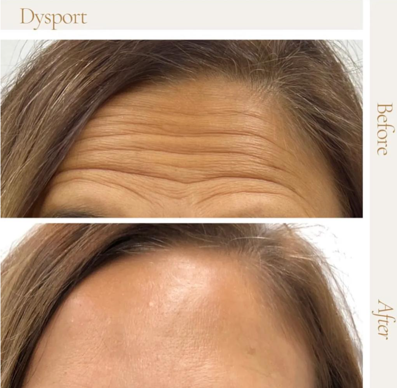 BOTOX vs Dysport vs Jeuveau What Is the Difference