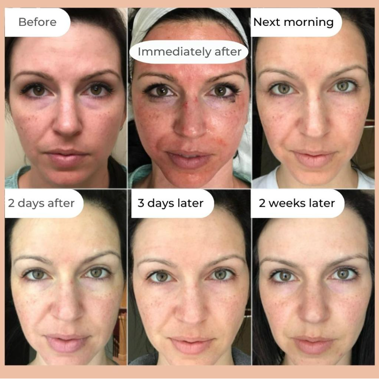 Microneedling for Collagen Production How the Process Works