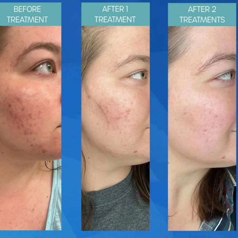 Microneedling for Collagen Production How the Process Works