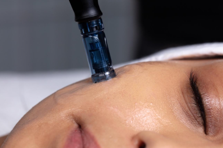 Microneedling for Collagen Production How the Process Works