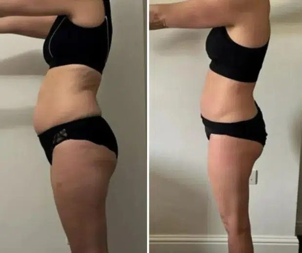 Why Muscle Tone Matters in Body Contouring Results